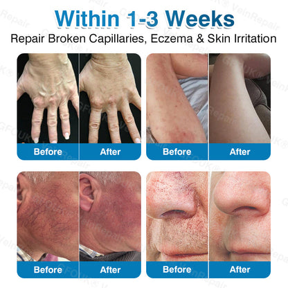 🇨🇦🏆✅️🏃ROVINAO® VeinRepair Microneedle Patch Roll⚡Instant Relief, Long-Term Results